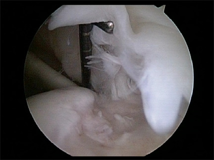 Partial Tear of the Rotator Cuff