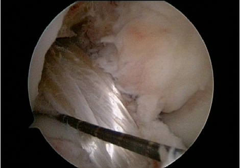 Tool helping with ACL Graft
