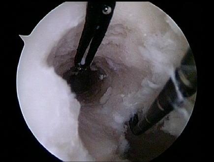 Tunnel drilled in femur for ACL graft