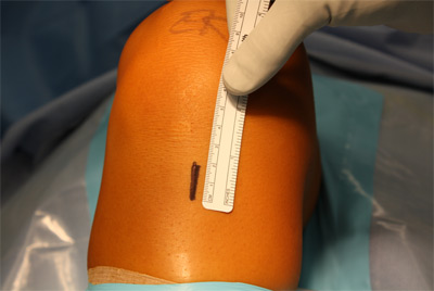 Incision used for hamstring graft harvest and drilling tibial tunnel
