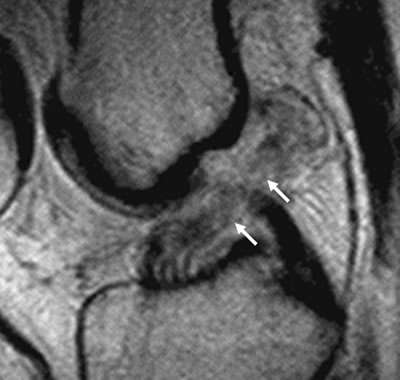 MRI of torn ACL image