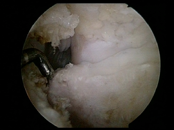 Bone Spur at Olecranon | Elbow Arthroscopy | Orthopedic Surgery Pictures