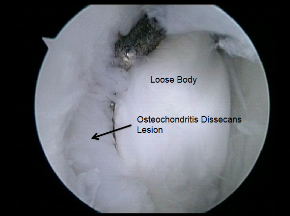 Arthroscopic View of Loose Body | Elbow Loose Body Removal | Dr. Khalfayan