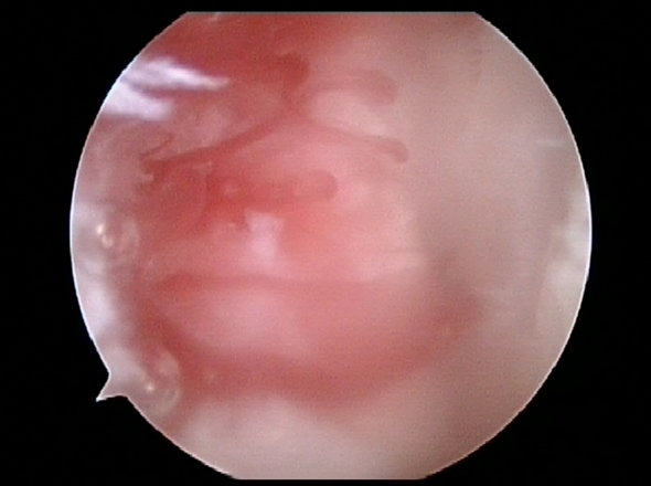Bleeding from Microfracture Site | Osteochondritis Dissecans | Dr. Khalfayan