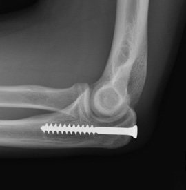 Xray of Healed Elbow after Surgery