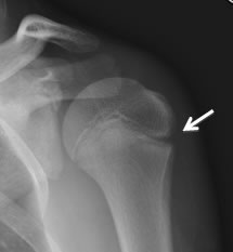 X-ray shows normal side of shoulder