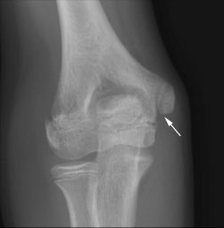 Xray of Normal Medial Epicondyle growth plate