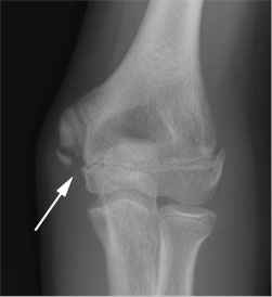 Widening of the Medial Epicondyle growth plate with fracture of the bottom aspect