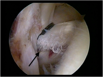 Black arrow shows tear as the tendon is pulled into joint