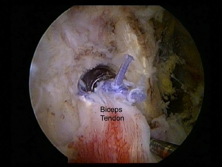 Screw holds the bicep tendon in socket
