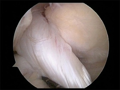 Image of Heathly ACL
