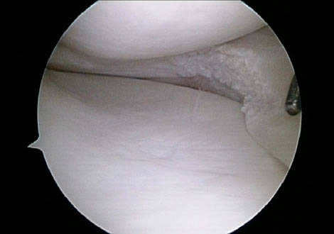 Medial Meniscus following removal of flap tear