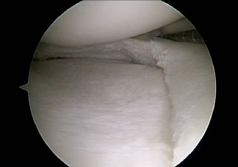Medial Meniscus after partial removal of a degenerative tear in a runner