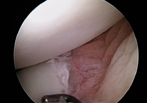 Front of repairable tear (black line) showing it is next to the joint capsule (red tissue) with a good blood supply