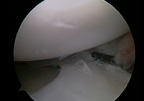 Repaired front portion of meniscus