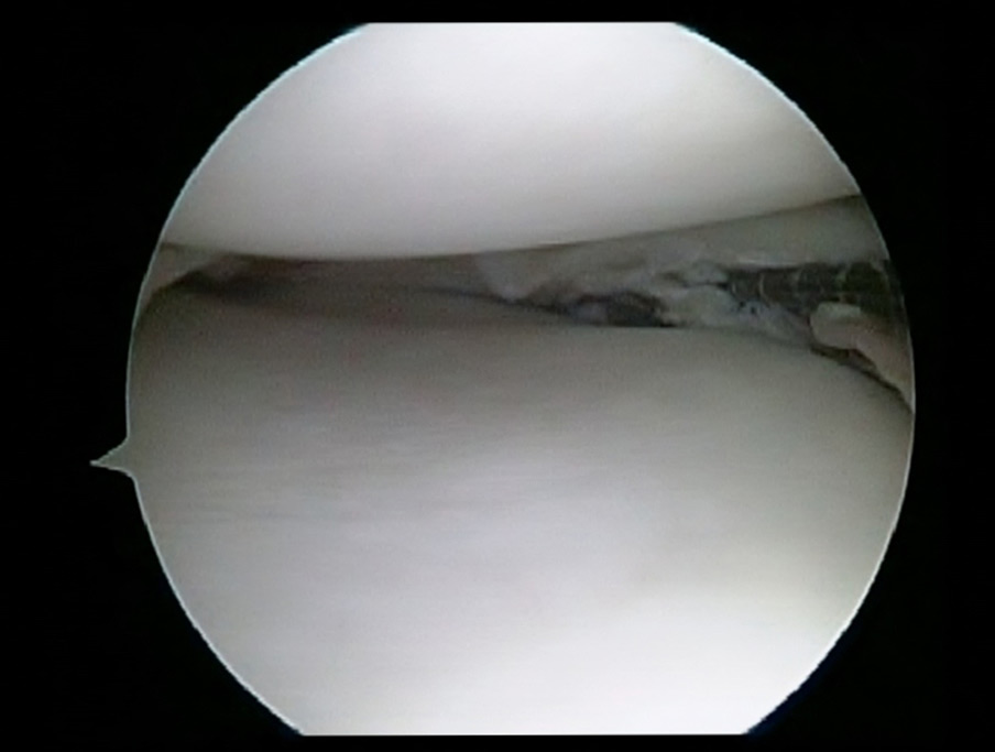 Large Peripheral Medial meniscus Tear