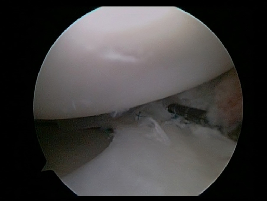 Repaired front portion of Meniscus