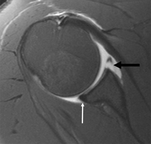MRI Bankart tear