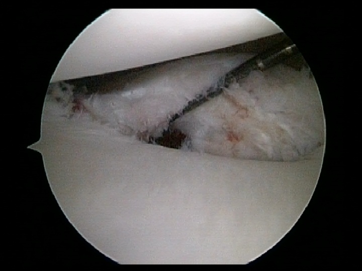 Close up Bankart Lesion