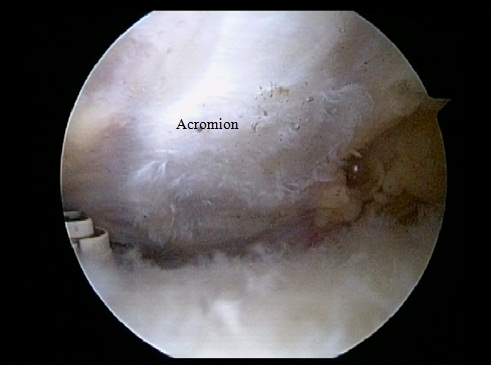 Acromion