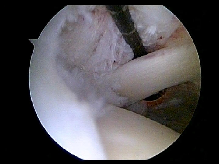Rotator Cuff Tear of ShoulderJoint
