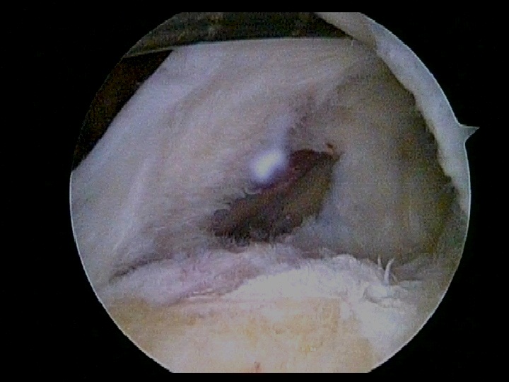 Rotator Cuff Tear Tuberosity