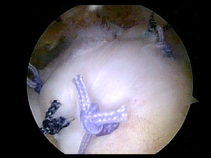Repaired Rotator Cuff Teer