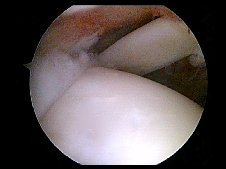 Repaired Rotator Cuff Shoulder Joint
