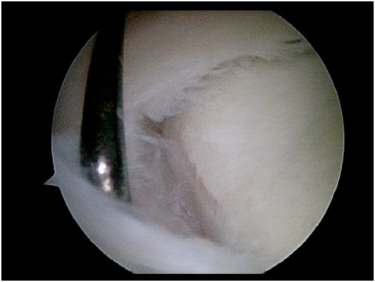 Unstable SLAP Tear