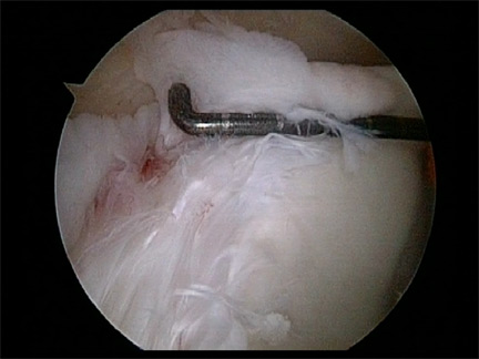Arthroscopic views of Internal Impingement