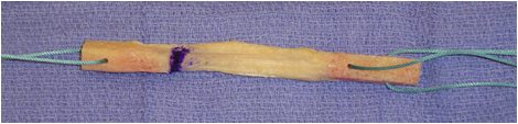 Patellar Tendon Graft