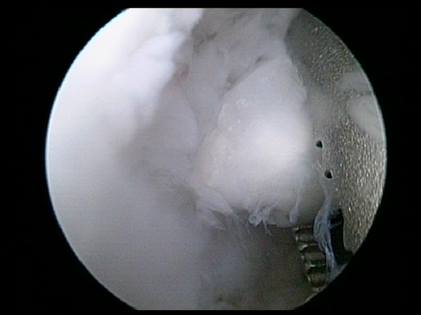 Loose Body Being Removed from Elbow | Dr. Khalfayan Orthopedic Surgeon