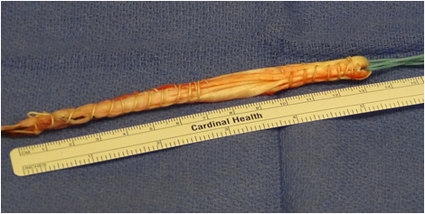 Four Stranded Hamstring Graft
