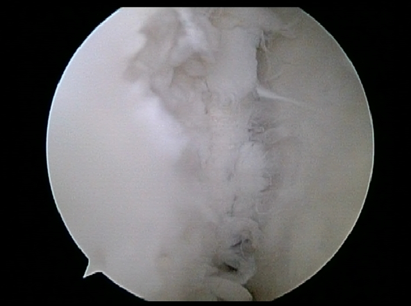 Osteochondritis Dissecans Lesion | Elbow Arthroscopy | Dr. Khalfayan