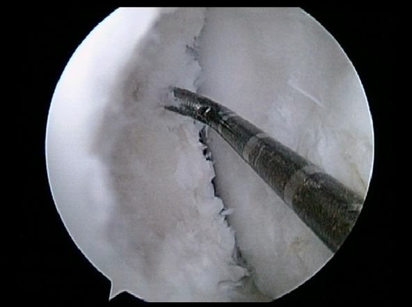 Lesion Prepared for Microfracture | Osteochondritis Dissecans | Dr. Khalfayan