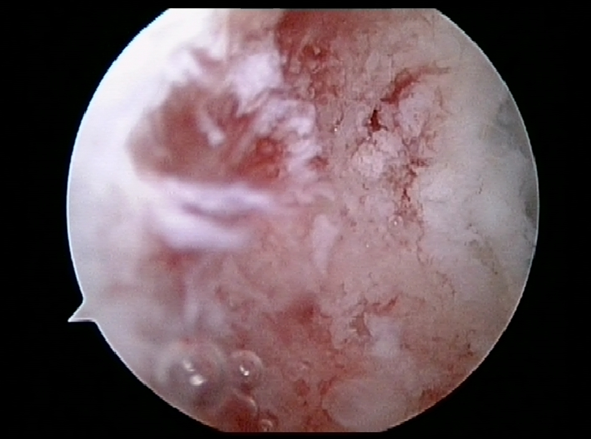 Microfracture of Capitellum | Osteochondritis Dissecans | Elbow Arthroscopy