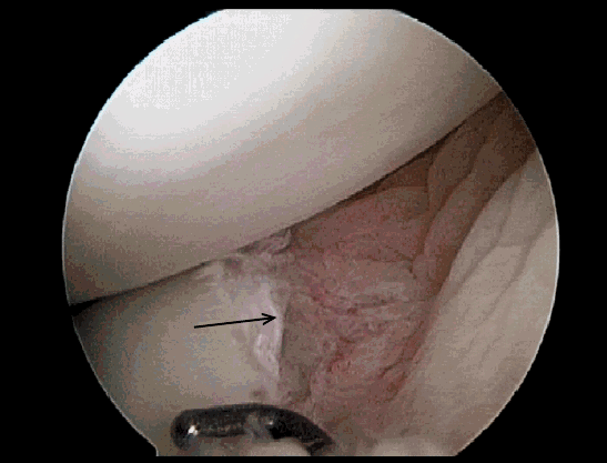 Meniscus Tear Arthroscopic Surgery