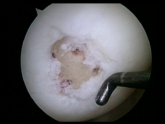 ANTHROSCOPIC_MICROFACTURE_3.PNG