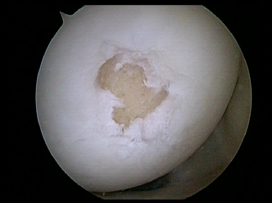 Anthroscopic_Microfacture_2.png