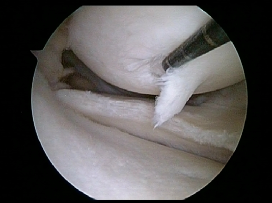 Anthroscopic_Microfacture_1.png