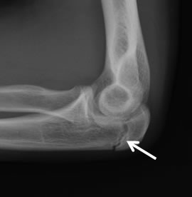 Xray of Olecranon Stress Fracture