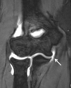 Elbow Injury: UCL Tear off the Ulnar attachment 