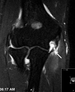 Elbow Injury: UCL Tear in midportion of ligament