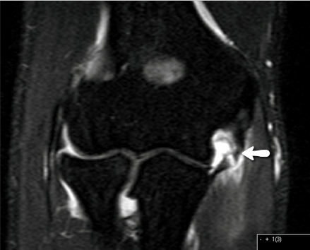 UCL Tear (white arrow at tear with leakage of dye)