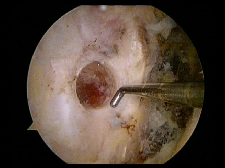 socket created in the humerus