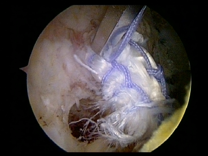 Bicep Tendons