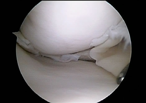 Flap Tear of Medial Meniscus