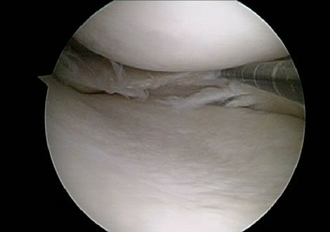 Degenerative Medial Meniscus Tear in a runner