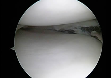 Large Peripheral Medial Meniscus Tear