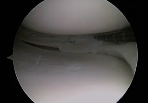Repaired Meniscus